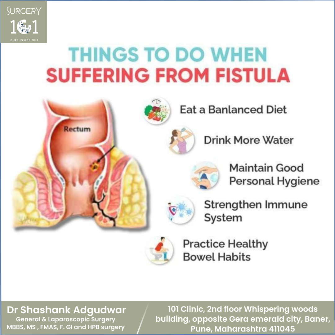 Things to Do When Suffering from Fistula
