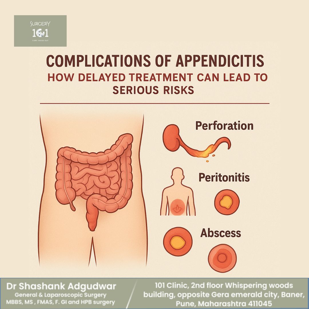 Appendix Treatment: Delayed Risks & Appendix Surgery